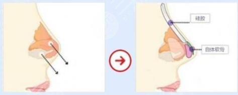 自体脂肪隆鼻