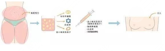 脂肪丰胸