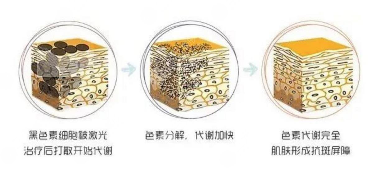 邢台市人民医院美容科人气项目(1)皮秒激光