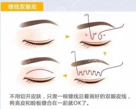 埋线双眼皮