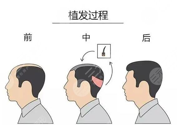 微针植发技术