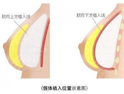广医二院隆胸后效果