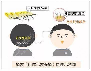 吉大二院植发案例|网友植发恢复日记：术中