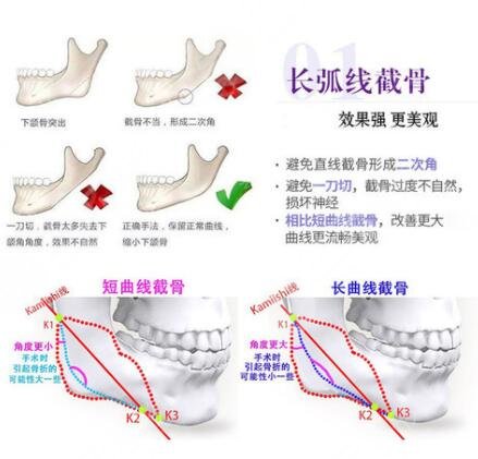 下颌角整形包含着哪些不同的项目呢