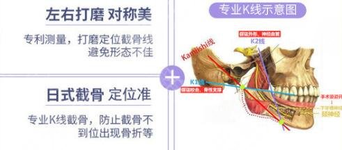 下颌角整形究竟适合哪些人群