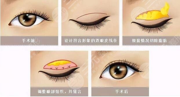 广州,美莱,双眼皮,做的好不好