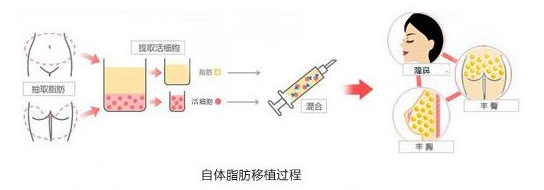 北京协和整形外科擅长项目科普：面部脂肪填充