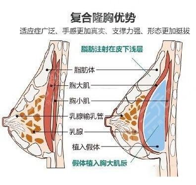 成都科思研医院详情介绍|附假体隆胸果对比