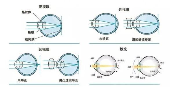 眼睛多少度适合做近视眼激光手术