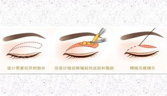 双眼皮项目科普
