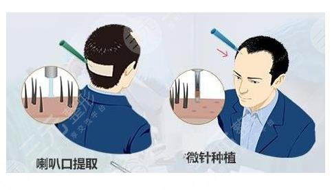 植发项目科普