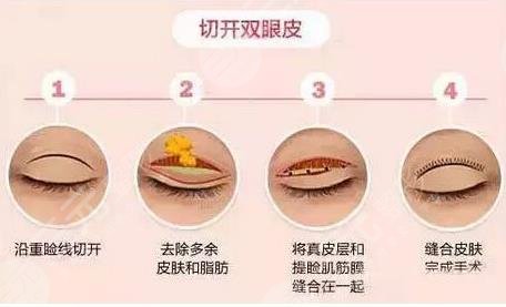 双眼皮相关知识科普