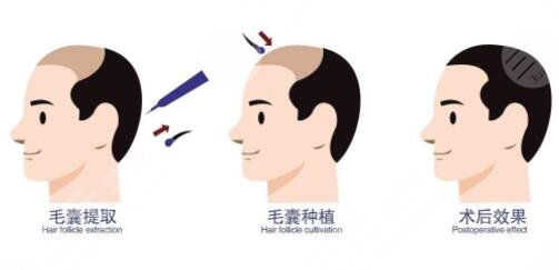 发际线移植