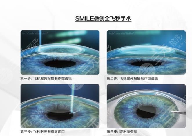 近视眼激光手术前需要做什么准备?
