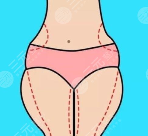 北京柠悦世贸医疗美容大腿吸脂案例