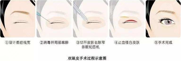 溢美医疗美容双眼皮案例