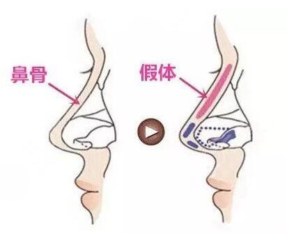 隆鼻整形案例