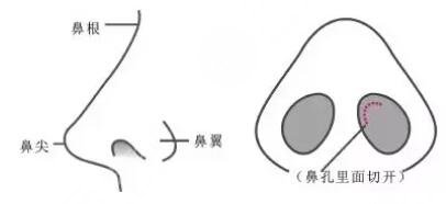硅胶隆鼻手术禁忌人群