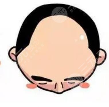 华西医院植发际线案例分享