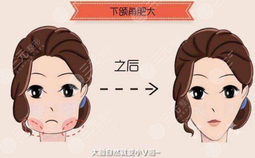 下颌角整形手术后多久可以恢复正常生活