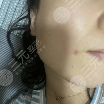 乐山武警医院有美容整形科祛痣过程