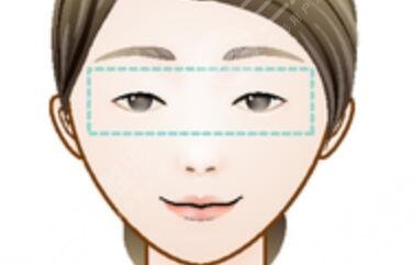 昆华医院医美双眼皮案例