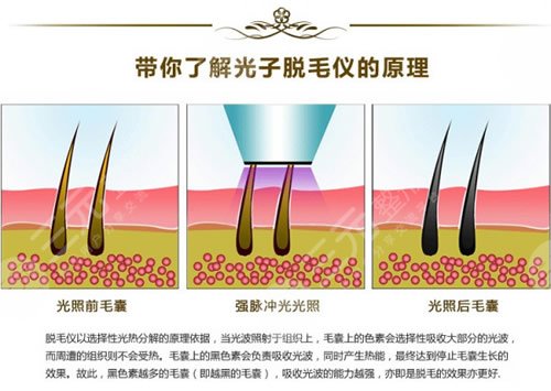 杭州连天美医疗美容医院光子脱毛介绍：原理