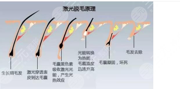 杭州连天美医疗美容医院光子脱毛介绍：优点