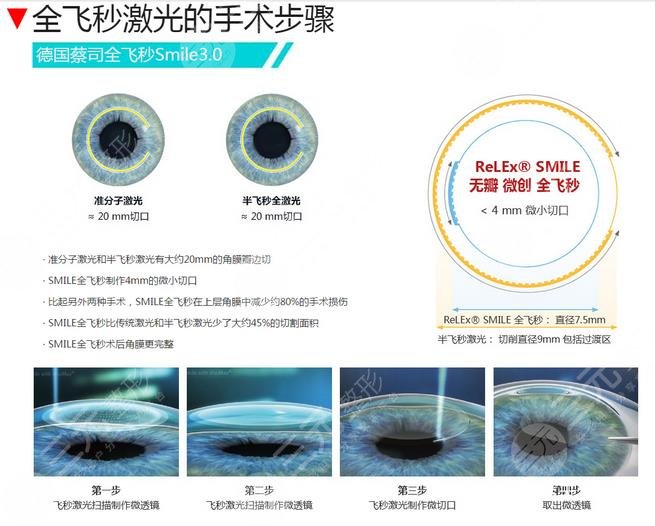 西安华夏眼科医院全激光飞秒手术介绍