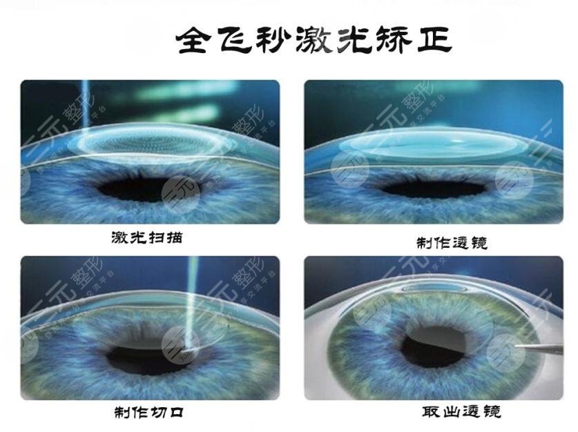 上海新视界眼科医院全激光飞秒手术科普：费用