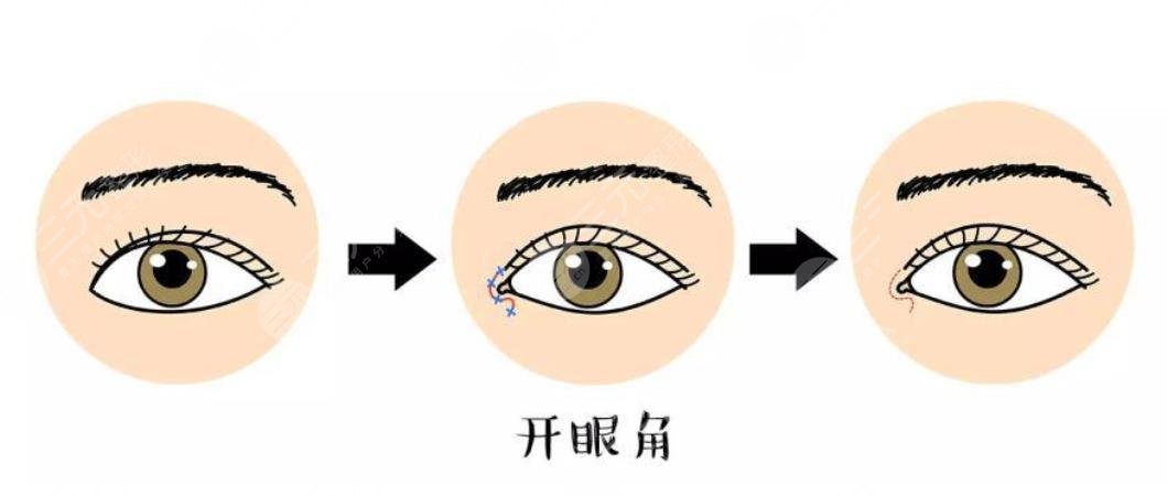 牡丹江人民医院烧伤整形科开眼角科普