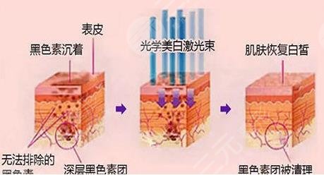 光子嫩肤术前需要准备什么?
