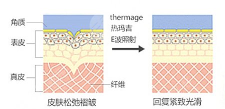 热玛吉相关知识科普