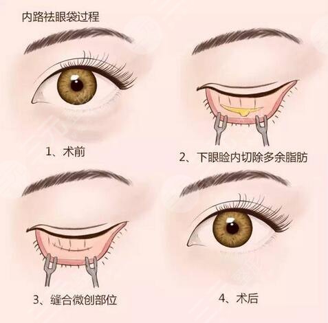 眶隔释放去眼袋的技术特点有哪些