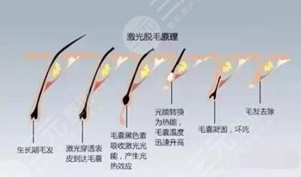光子脱毛注意事项有哪些