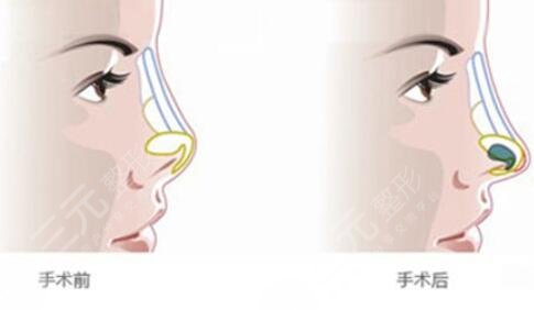 全肋骨隆鼻手术适合人群