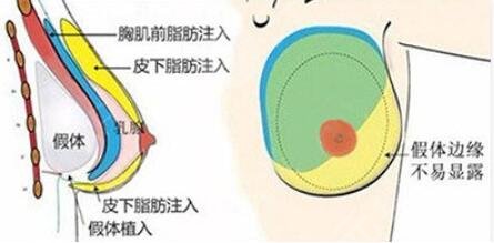隆胸手术的介绍