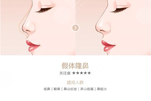 假体隆鼻