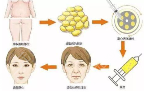 脂肪填充