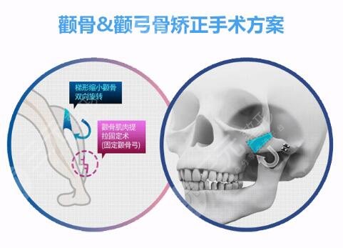 磨骨之后疼吗