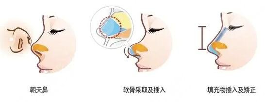 隆鼻