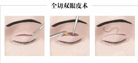 眼部整形
