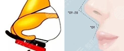 垫鼻尖整形后多久能恢复