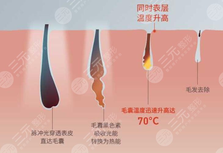 光子脱毛