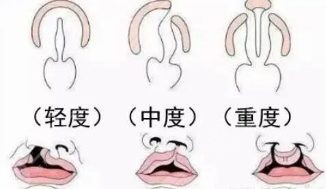 唇腭裂