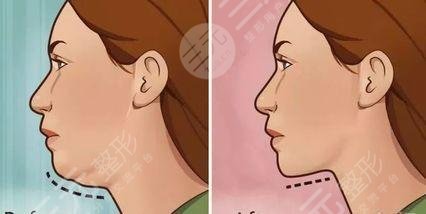 北京瑞丽医疗美容医院热玛吉术前