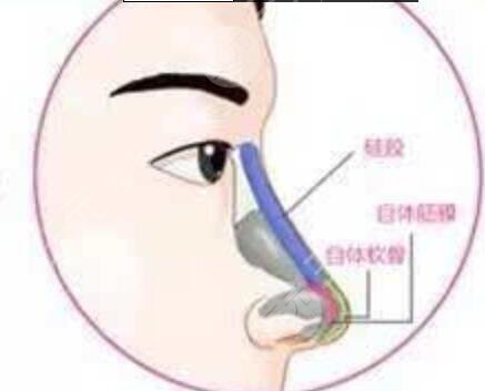 上海南山医院整形科隆鼻