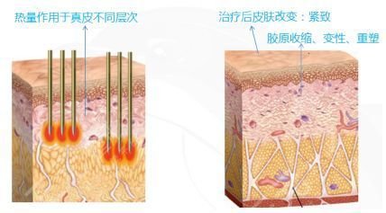 热玛吉的费用是多少呢?