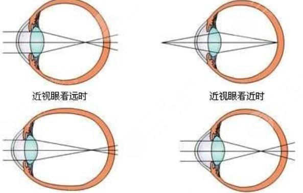 近视眼矫正