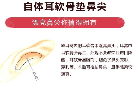 牡丹江市整形美容医院科普鼻整形相关知识